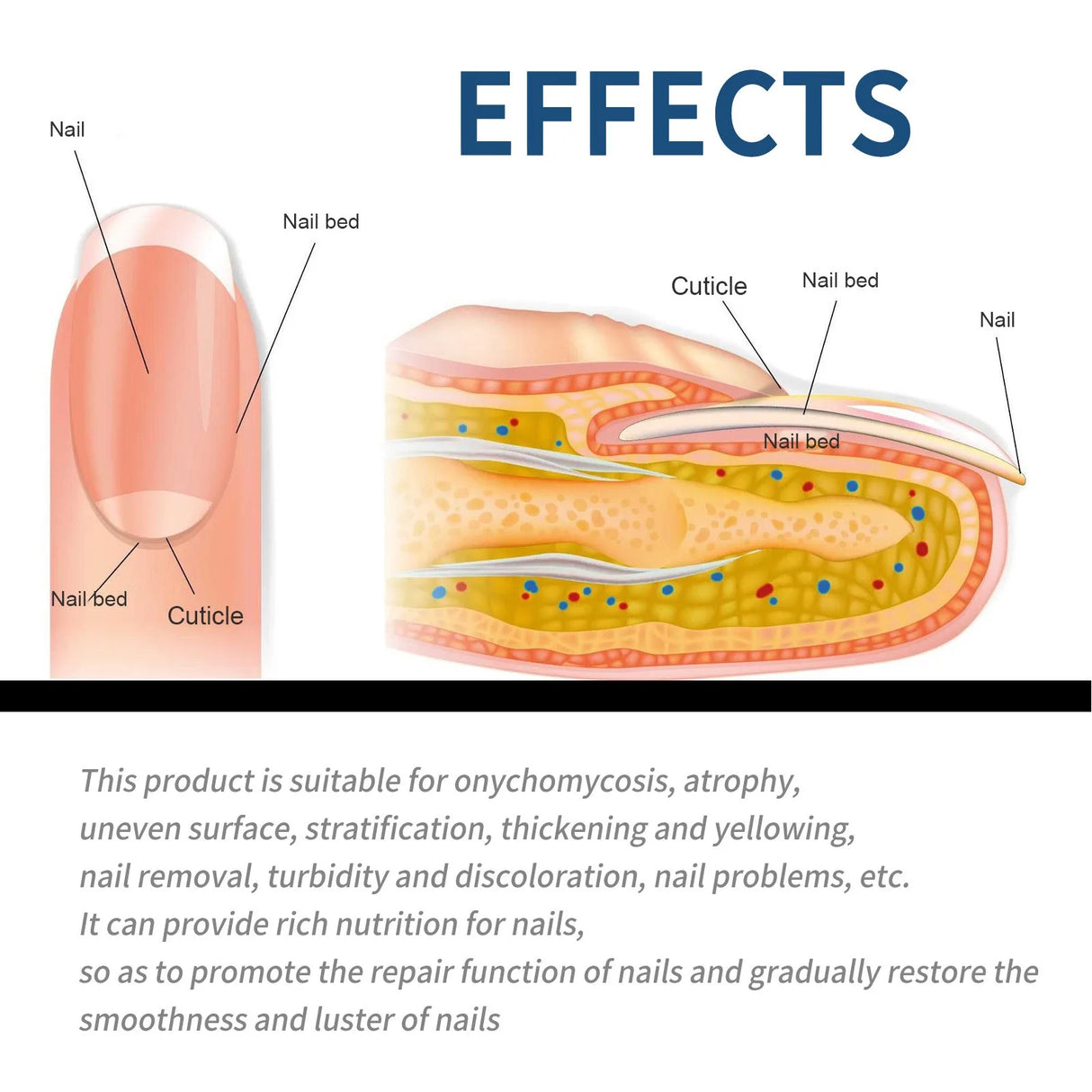 (Pack of 64) 32/ Paronychia Treatment Patch Fungus Removal Nail Ingrown Correction Stickers Nails Recover Pedicure Tools Health Care