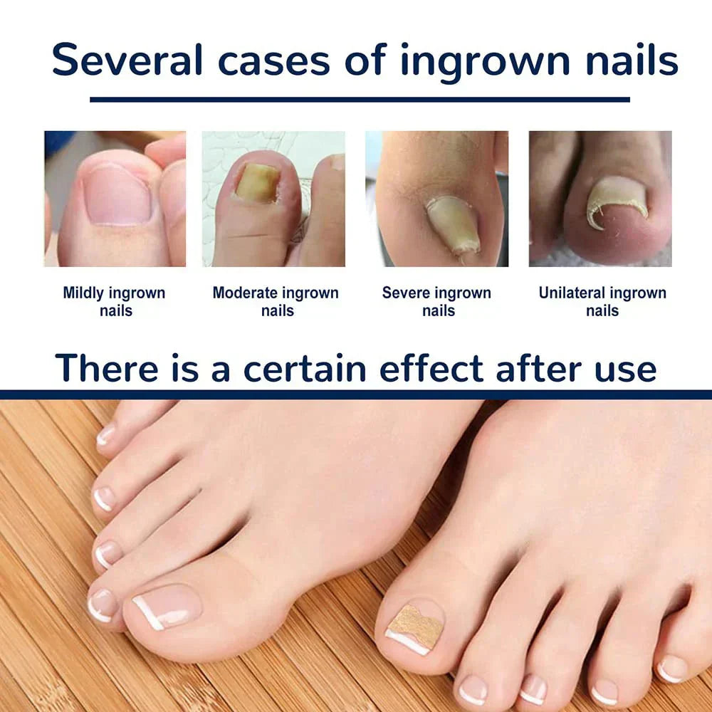 (Pack of 100) 50/ Ingrown Toenail Corrector Patches Nail Correction Care Stickers Paronychia Treatment Recover Corrector Pedicure Tool