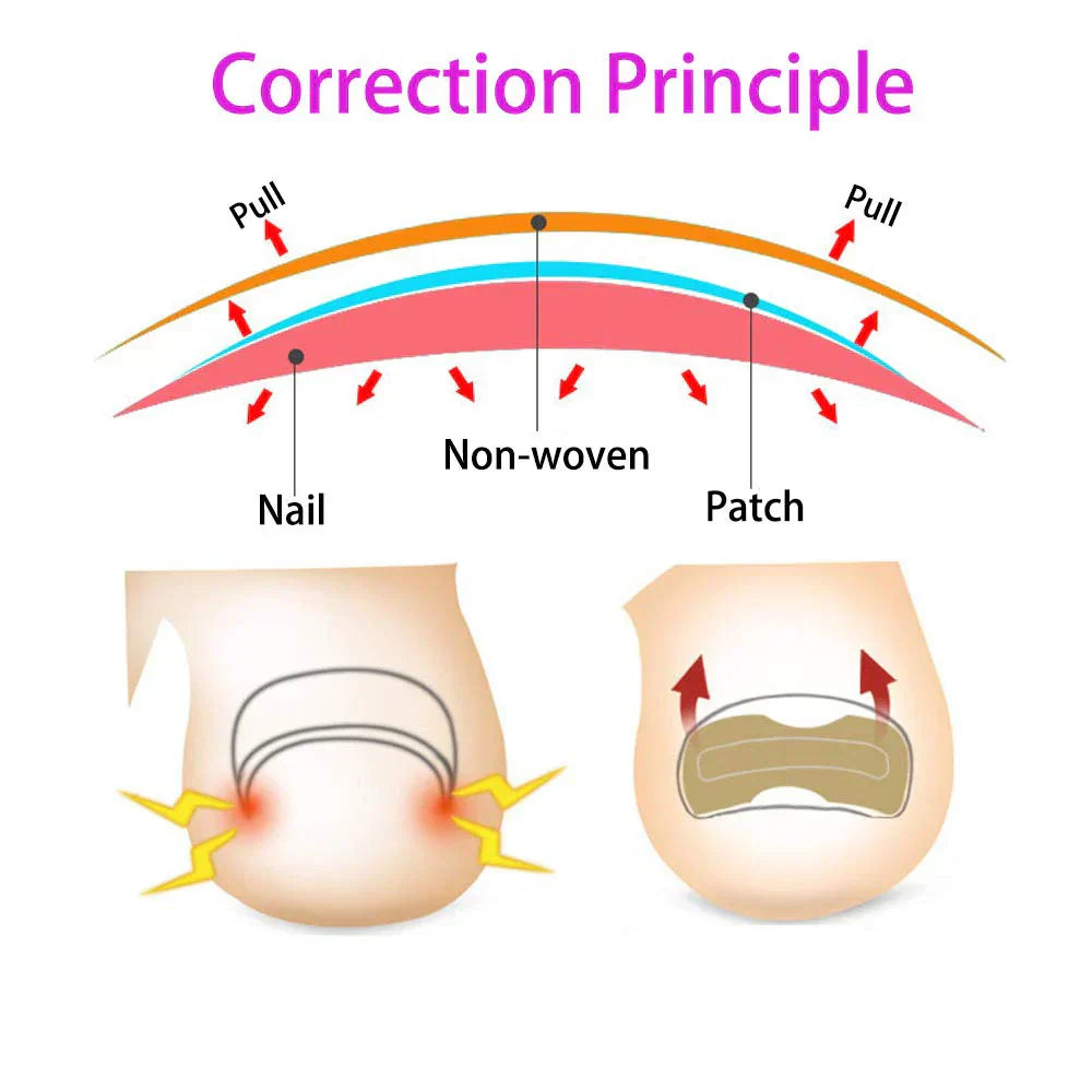 (Pack of 100) 50/ Ingrown Toenail Corrector Patches Nail Correction Care Stickers Paronychia Treatment Recover Corrector Pedicure Tool