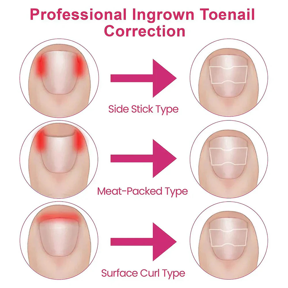 (Pack of 100) 50/ Ingrown Toenail Corrector Patches Nail Correction Care Stickers Paronychia Treatment Recover Corrector Pedicure Tool