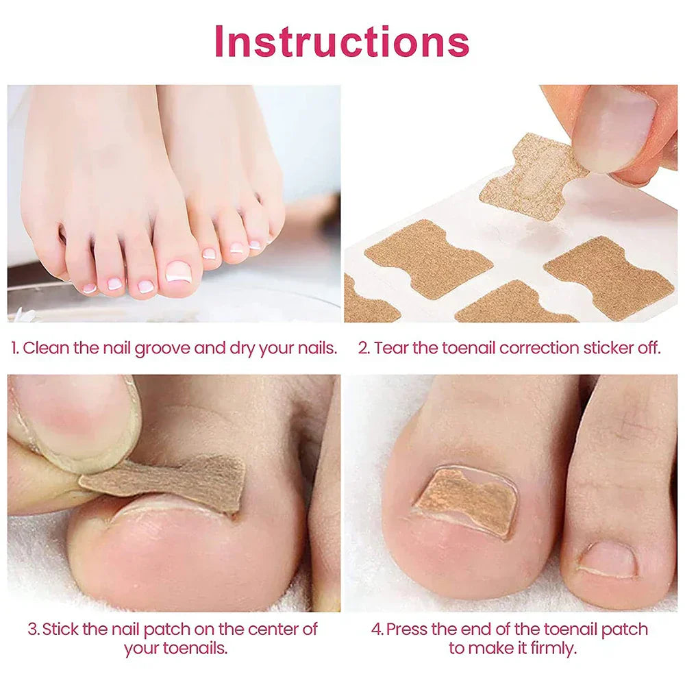 (Pack of 100) 50/ Ingrown Toenail Corrector Patches Nail Correction Care Stickers Paronychia Treatment Recover Corrector Pedicure Tool
