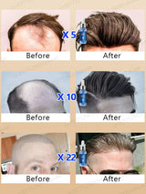 Fast Hair Growth Essence Oil Products Effective Baldness Repair Treatment Anti Hereditary Seborrheic Alopecia Loss For Men Women