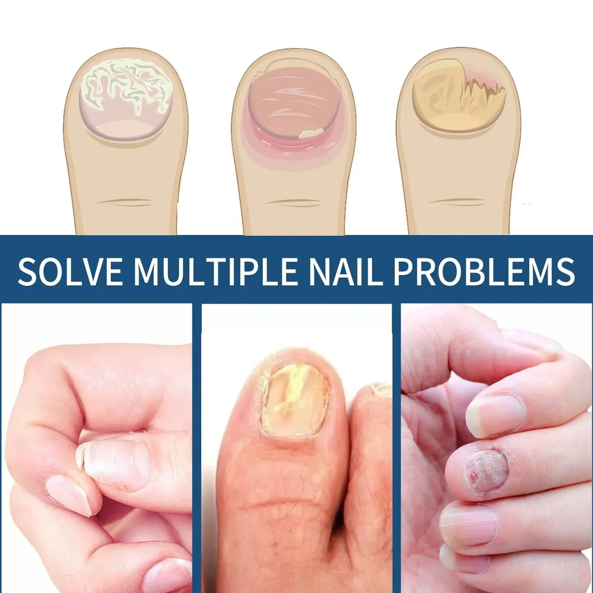 (Pack of 64) 32/ Paronychia Treatment Patch Fungus Removal Nail Ingrown Correction Stickers Nails Recover Pedicure Tools Health Care